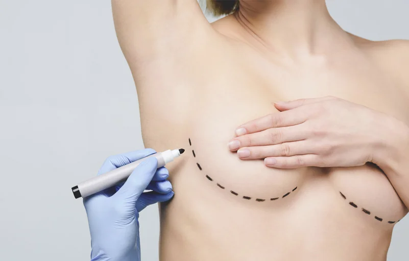 Foto de preparação para circurgia das mamas